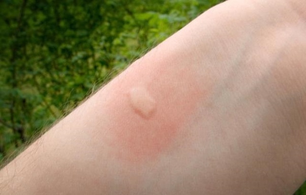 mosquito bite on arm