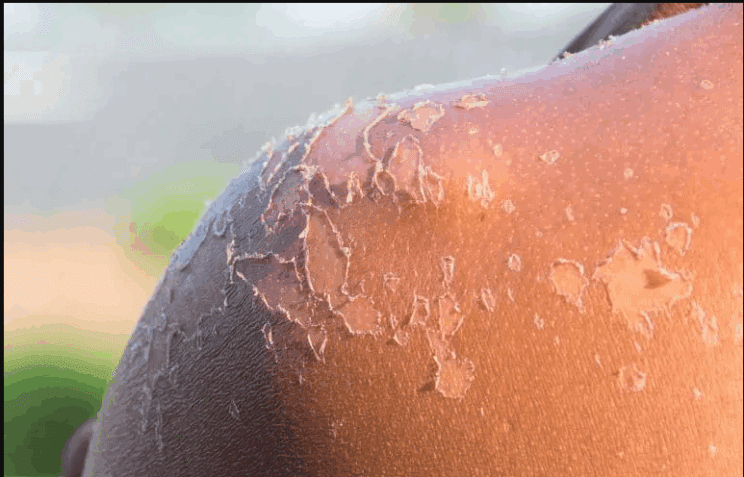 Opekline: Kaj se v resnici zgodi z vašo kožo, ko vas opeče sonce? 3 opekline