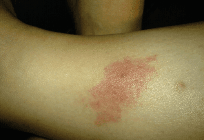 Veterinarji opozarjajo: zaščitite pse pred peščeno muho 2 peščene muhe