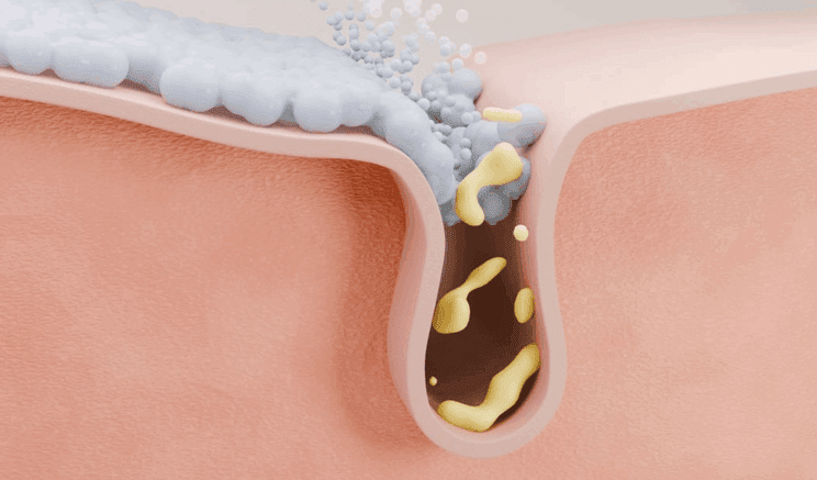 Kako se znebiti razširjenih por na obrazu? 2 pore na obrazu