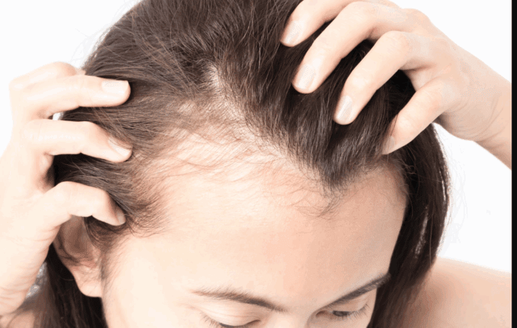 Polovica žensk do 50. leta starosti ima neko obliko izpadanja las! 2 izpad las